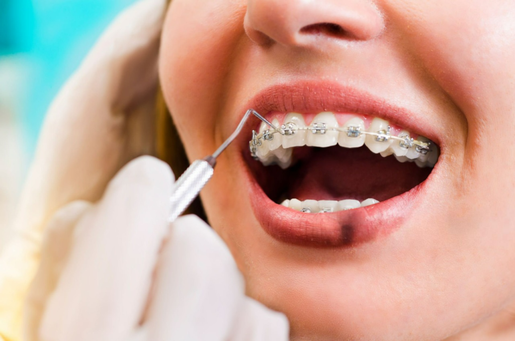 best invisalign center in dubai